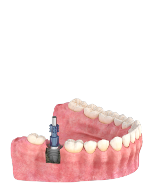 Impression Copings L